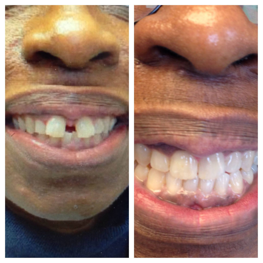 Invisalign-Before-After-Photos